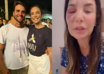 Ivete Sangalo se recupera de cirurgia facial com apoio do ex-marido