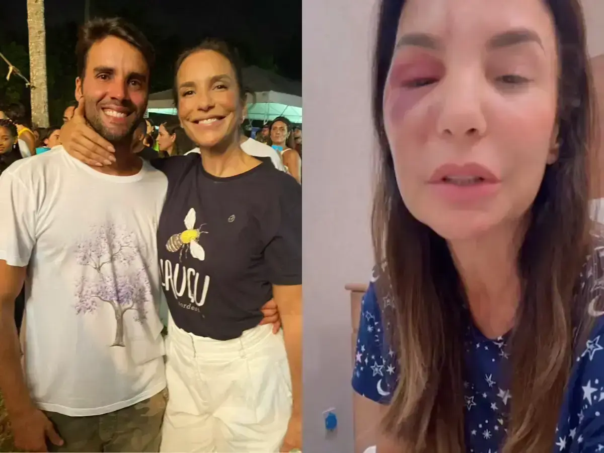 Ivete Sangalo se recupera de cirurgia facial com apoio do ex-marido