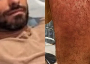 Lucas Malvacini é hospitalizado após ataque de ácaros em viagem à Indonésia