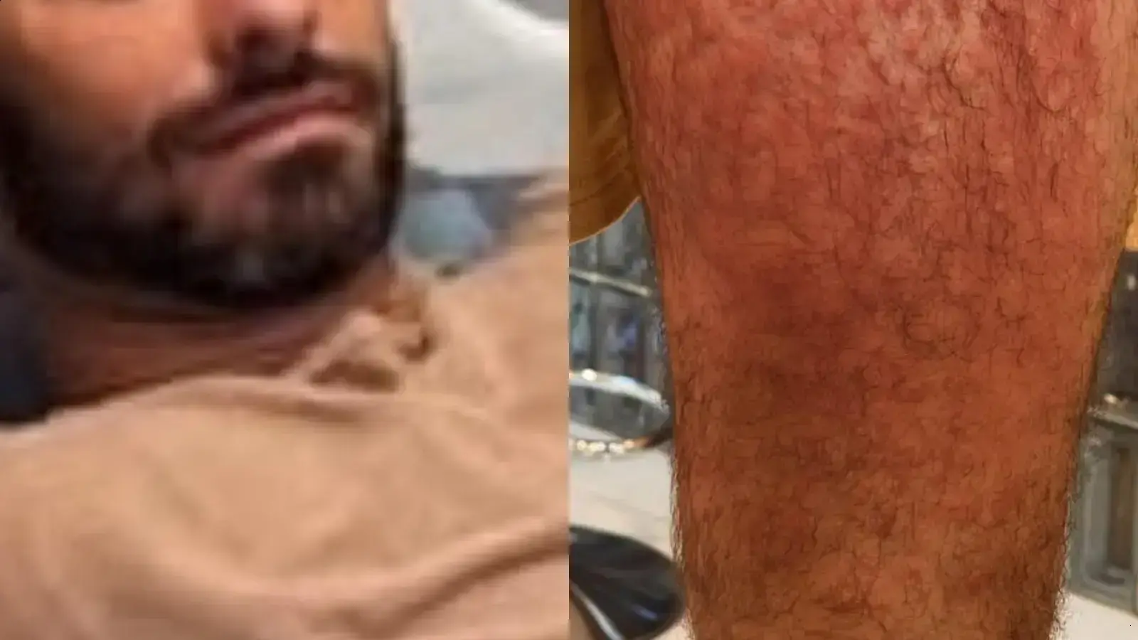 Lucas Malvacini é hospitalizado após ataque de ácaros em viagem à Indonésia