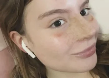 Sophia Valverde exibe novo nariz após rinoseptoplastia bem-sucedida