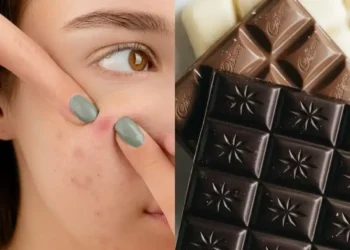 Chocolate e acne: o que você precisa saber nesta Páscoa