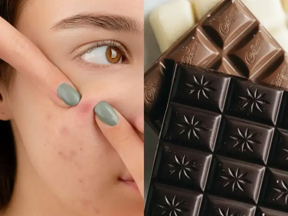 Chocolate e acne: o que você precisa saber nesta Páscoa