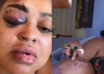 Rízia Cerqueira e o Acidente: Impacto e Recuperação Após Queda de Moto