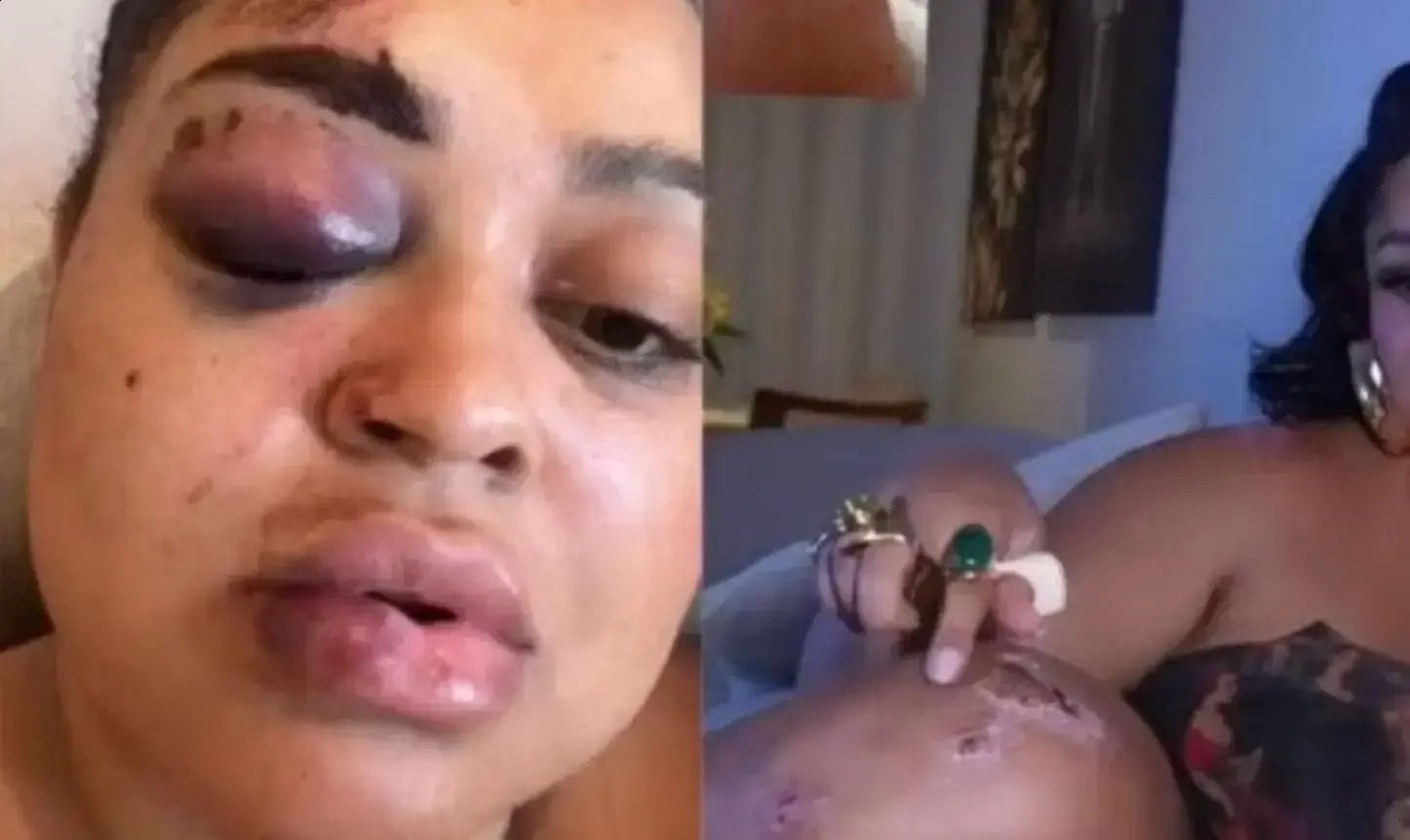 Rízia Cerqueira e o Acidente: Impacto e Recuperação Após Queda de Moto