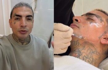 Transformação de MC Guimê após procedimento facial surpreende; médico explica as mudanças